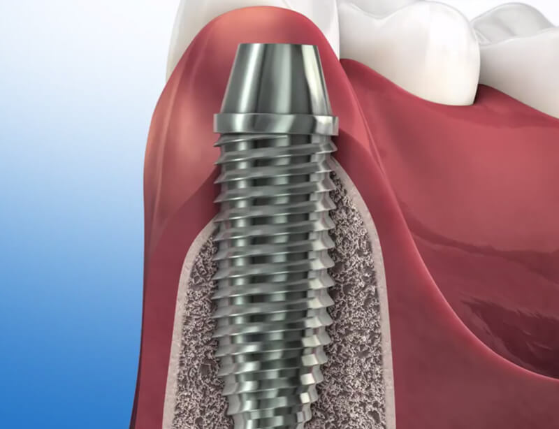 fogimplantátum - implantológia