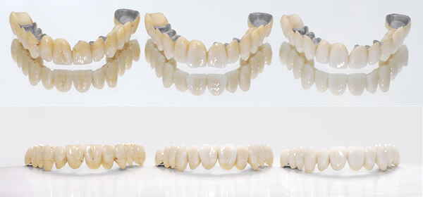 Dentures - Prothesis - 03