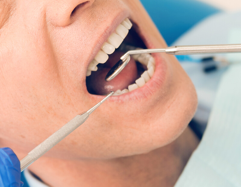 fogágybetegségek kezelése - parodontológia