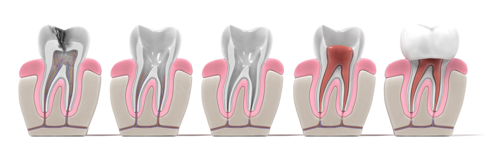 Endodontie - Step by Step