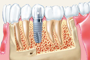 Dental Implantation in Sopron